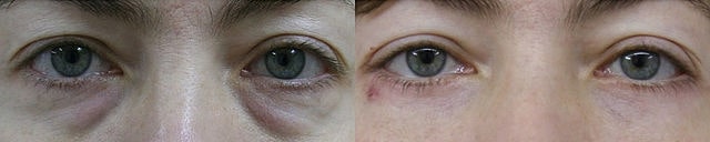 Blefaroplastia após a cicatrização completa. Imagem de cirurgia disponibilizada nos termos Creative Commons CC0 1.0.