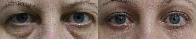 Blefaroplastia após a cicatrização completa. Imagem de cirurgia disponibilizada nos termos Creative Commons CC0 1.0.