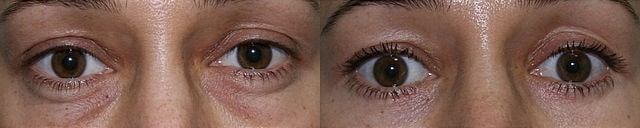 Blefaroplastia após a cicatrização completa. Imagem de cirurgia disponibilizada nos termos Creative Commons CC0 1.0.