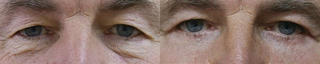 Blefaroplastia após a cicatrização completa. Imagem de cirurgia disponibilizada nos termos Creative Commons CC0 1.0.