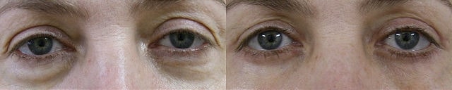 Blefaroplastia após a cicatrização completa. Imagem de cirurgia disponibilizada nos termos Creative Commons CC0 1.0.